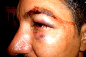 Motorista e Fiscal são agredidos após acidente de transito